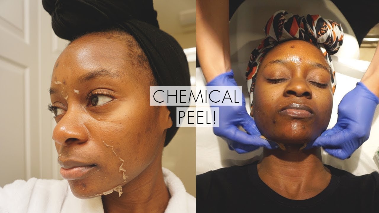 chemical peel treatment on dark skin