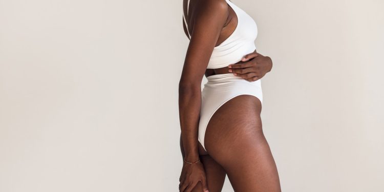 Stretch Marks: 5 of the Best Creams, Oils, and Scrubs To Fade Them Fast