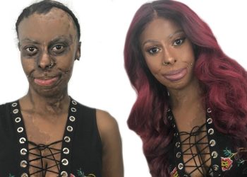 Watch Shalom Blac Make Over A Burn Victim With An Amazing And Inspirational Story