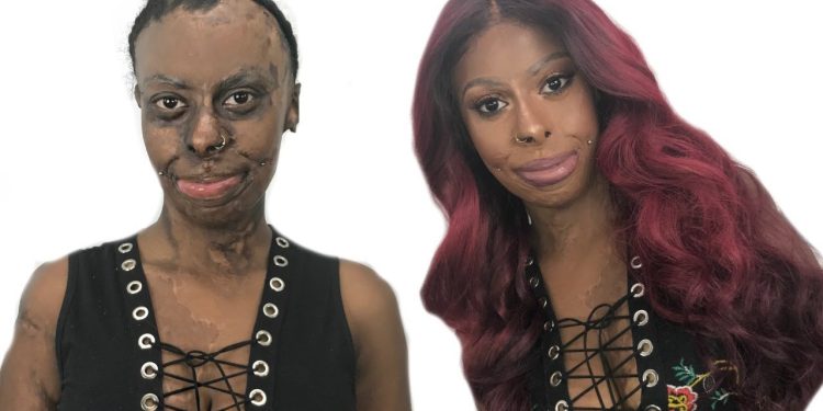 Watch Shalom Blac Make Over A Burn Victim With An Amazing And Inspirational Story