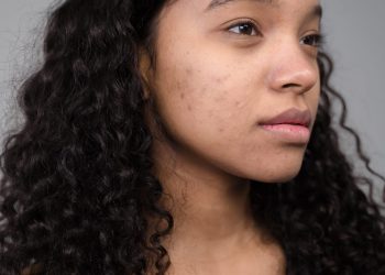 Here’s Everything You Need To Know About Doing Facial Peels At Home, Safely and Effectively